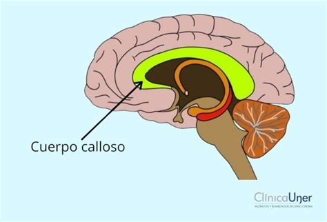 Esquema cerebral mostrando el cuerpo calloso y áreas afectadas en el síndrome de la mano ajena