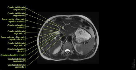 Imagen de resonancia magnética mostrando quistes hepáticos