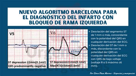 Ejemplos de ECG con infarto inferior y bloqueo de rama izquierda, y otro con ritmo de marcapasos.