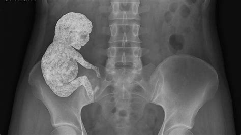 Radiografía de cadera mostrando un feto momificado en el abdomen
