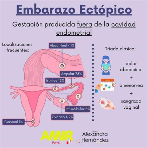 Esquema de un embarazo ectópico abdominal con formación de litopedia