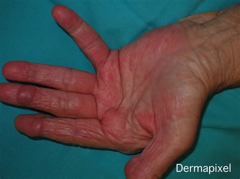 Nódulos reumatoides en la mano y el pie
