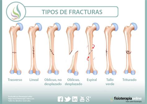 Diagrama de diferentes tipos de fracturas óseas (diafisaria, expuesta, conminuta)