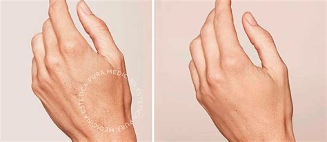Montaje fotográfico de antes y después del rejuvenecimiento de manos