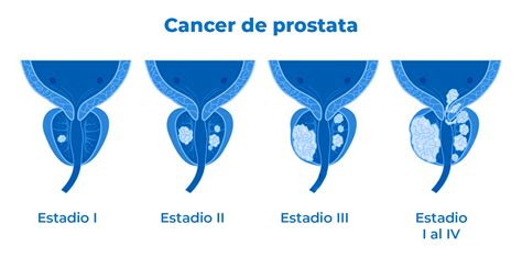 Mapa conceptual de etapas del cáncer de próstata y decisiones terapéuticas