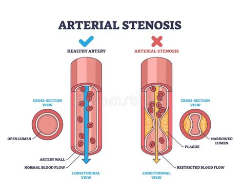 Infografía mostrando la evolución de una arteria sana a una arteria endurecida y con placa aterosclerótica