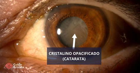 Imagen ilustrativa de un ojo con cataratas, mostrando la opacidad del cristalino.