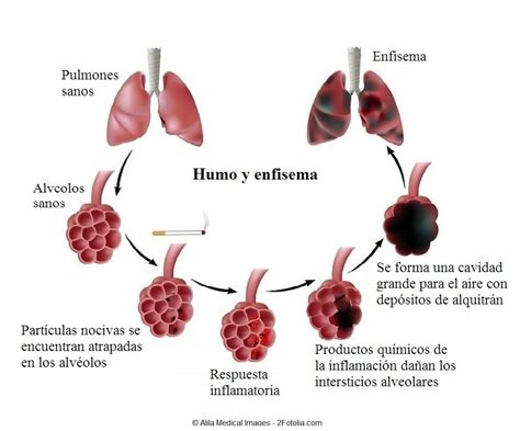 Ilustración comparativa de la anatomía pulmonar sana y afectada por enfisema y bronquitis crónica.