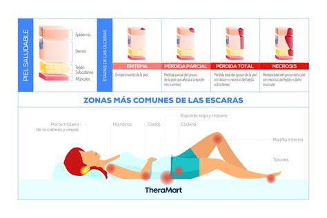 Infografía: Las 4 etapas de las escaras por presión