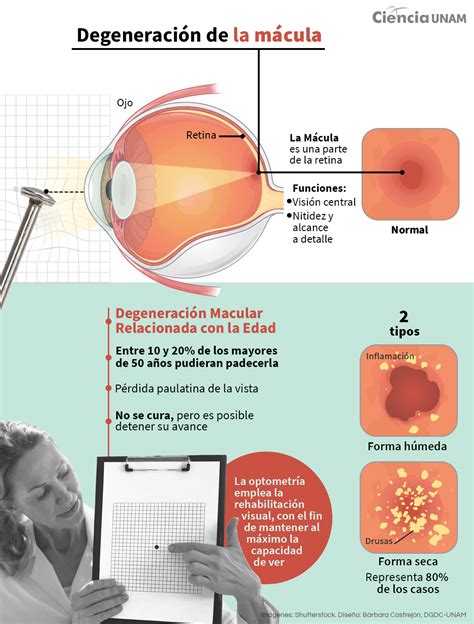 Infografía sobre los cambios del ojo con la edad: presbiopía, cataratas, degeneración macular