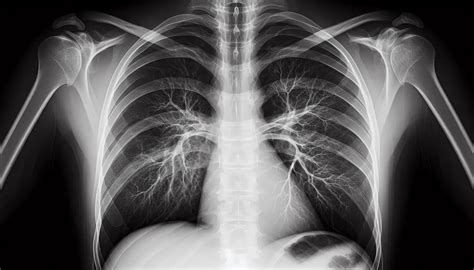 Radiografía de tórax mostrando infiltrados pulmonares por neumonía