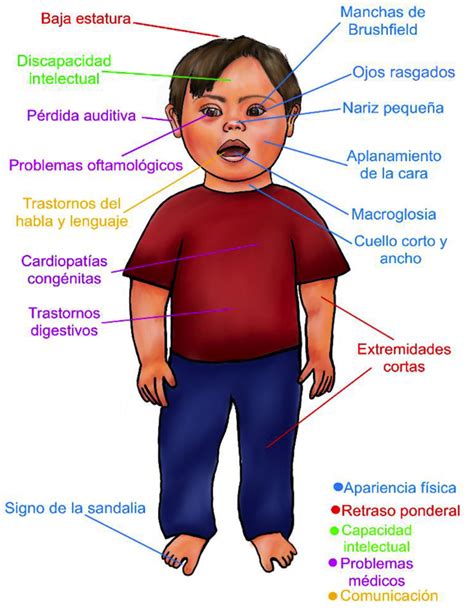 Ilustración que muestra a un niño con síndrome de Down, destacando algunos de sus rasgos faciales característicos.