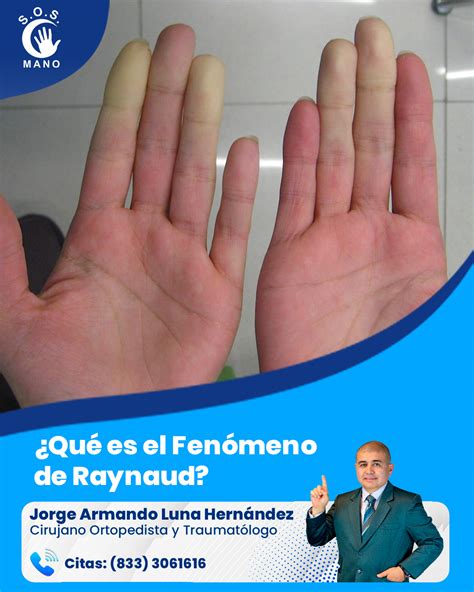 Fotografía de manos mostrando los cambios de color característicos (blanco, azul, rojo) durante un ataque de Raynaud.