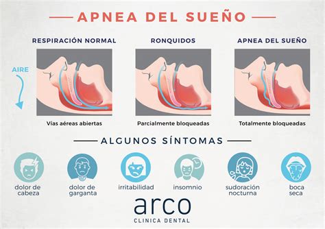 Esquema de las vías respiratorias durante una apnea del sueño