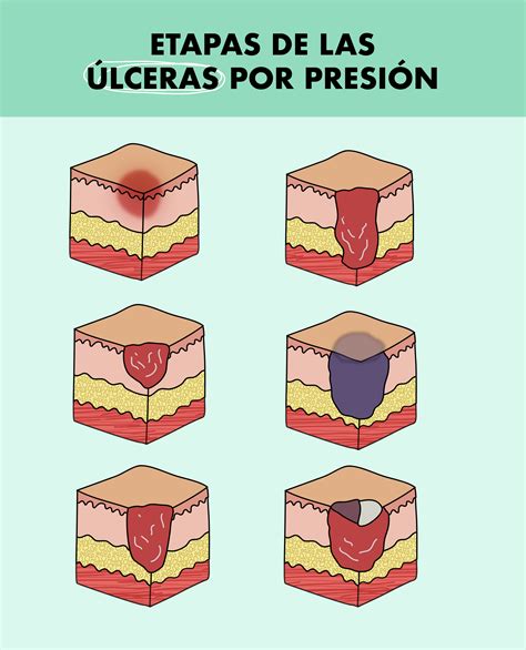 Infografía detallando las cuatro etapas de una úlcera por presión con imágenes representativas