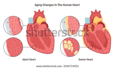 Ilustración de un corazón envejecido con válvulas endurecidas
