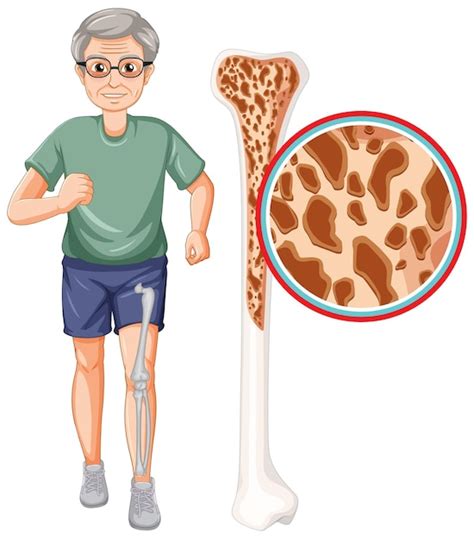 infografía sobre la prevalencia de osteoporosis en adultos mayores
