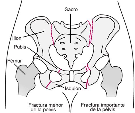 esquema anatómico de una fractura transtrocantérica