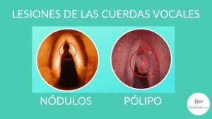 Esquema de las cuerdas vocales y sus posibles lesiones, como nódulos o quistes
