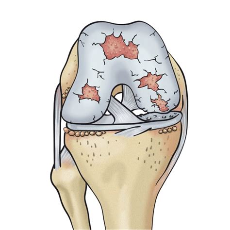 Radiografía de rodilla con osteoartritis mostrando desgaste de cartílago