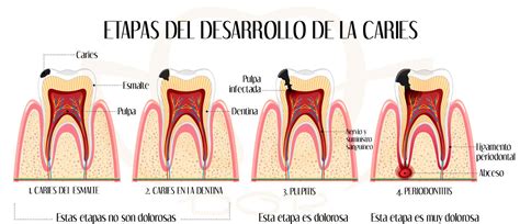 Esquema de las causas de la pérdida dental: caries, enfermedad periodontal, traumatismo, bruxismo