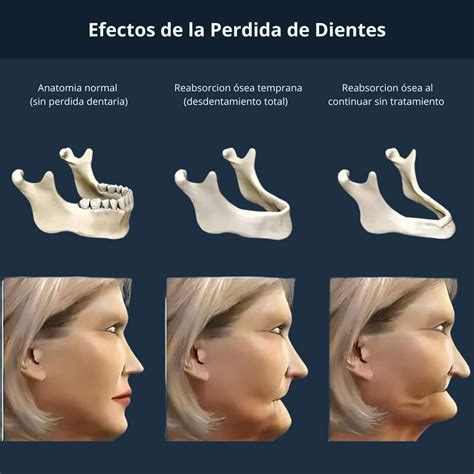 Infografía de las consecuencias de la pérdida de dientes: reabsorción ósea, desplazamiento dental, problemas de masticación, estética facial
