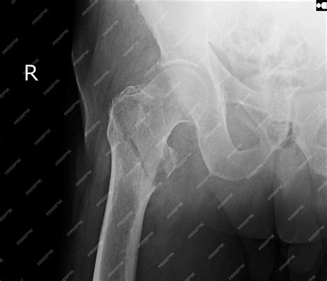 Radiografía de cadera con fractura visible