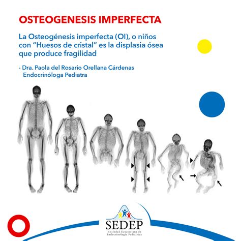 Esquema de la osteogénesis imperfecta, mostrando la fragilidad ósea y sus efectos en el cuerpo humano.