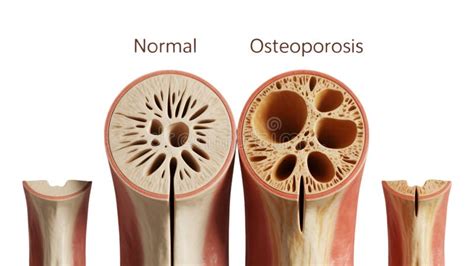 Esquema de la estructura ósea normal y osteoporótica