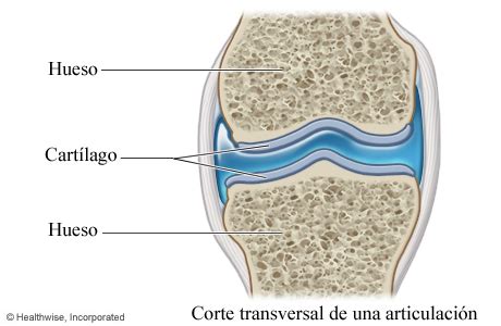 Representación del desgaste del cartílago en una articulación artrósica