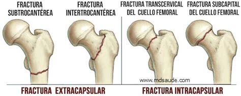Esquema de las diferentes zonas de fractura en el fémur proximal (cabeza, cuello, trocánter)