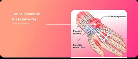 Esquema anatómico de la mano mostrando la inflamación de los tendones en la tenosinovitis de De Quervain