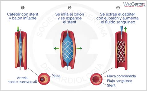 Flebografía mostrando la oclusión de venas y el proceso de angioplastia y liberación de stent