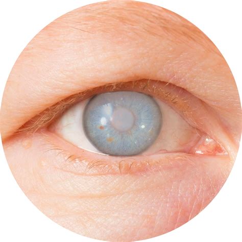 Ilustración de un ojo con catarata avanzada