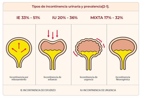 Diagrama que muestra los tipos de incontinencia urinaria: de esfuerzo, de urgencia, por rebosamiento y funcional.