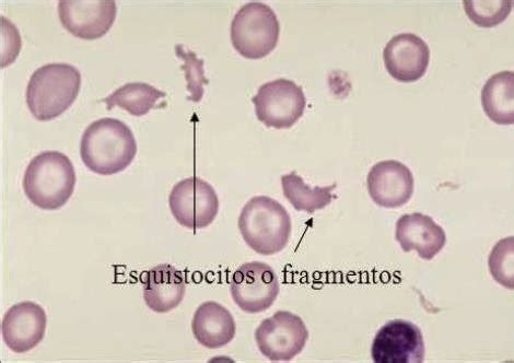 Imagen de esquistocitos (fragmentos de eritrocitos) en un frotis de sangre periférica