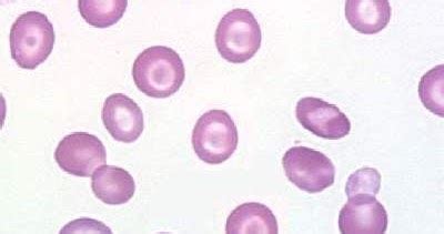 Imagen de dianocitos (células en blanco de tiro) en un frotis de sangre periférica