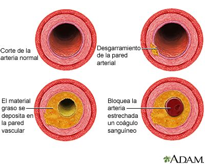Diagrama que ilustra la progresión de la aterosclerosis, mostrando la acumulación de placa en las arterias.