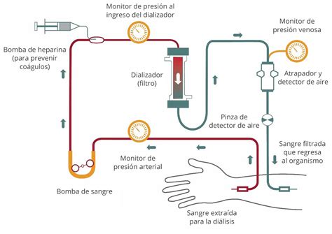 Diagrama de una máquina de hemodiálisis con los flujos de sangre y dializado
