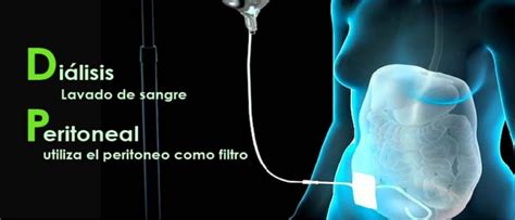 Ilustración de cómo funciona la diálisis peritoneal en la cavidad abdominal