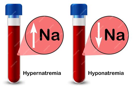 Gráfico que muestra la prevalencia de hiponatremia en diferentes poblaciones de personas mayores