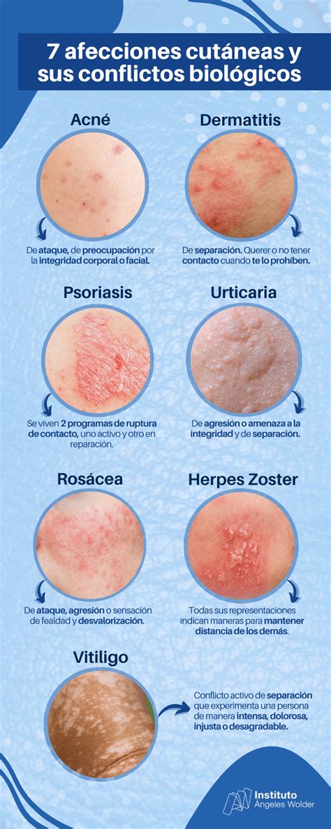 Imagen que ilustra las áreas afectadas por la irritación de la piel debido al babeo crónico.