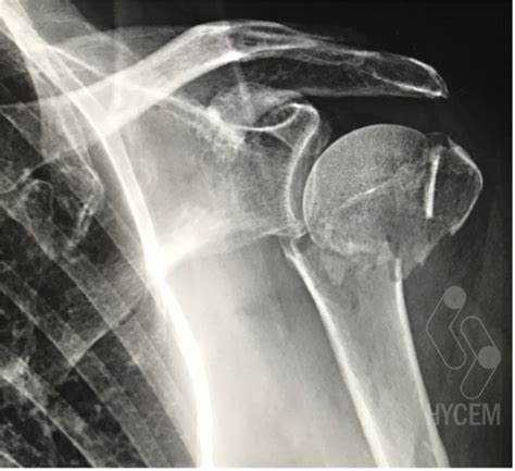 Radiografía de una fractura compleja de húmero proximal