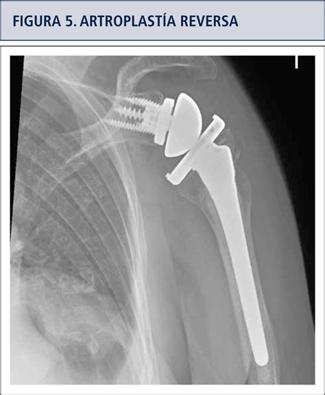 Radiografía postoperatoria de hombro con artroplastia inversa