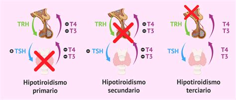 Infografía comparativa: Hipotiroidismo Primario (alteración en la glándula) vs. Secundario/Terciario (origen hipofisario o hipotalámico).