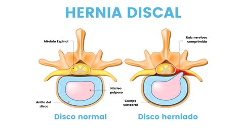 Diagrama que muestra una hernia discal comprimiendo un nervio espinal.