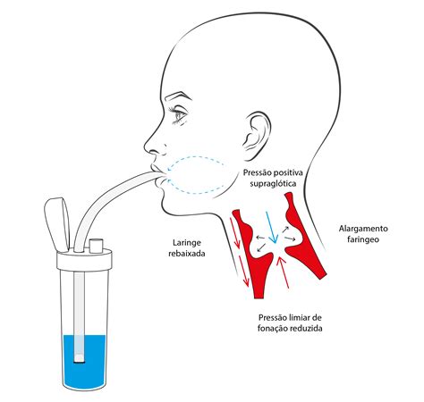 Esquema de la Terapia de Tracto Vocal Semiocluido (TVSO)
