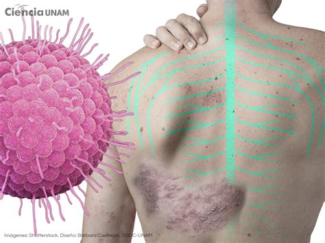 Esquema ilustrativo del recorrido nervioso del virus varicela-zóster desde los ganglios hacia la piel en una distribución dermatómica.