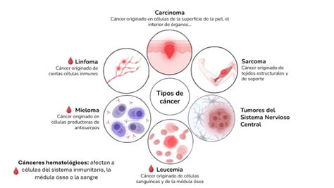 Infografía: Tipos de cáncer de hueso más comunes y su localización
