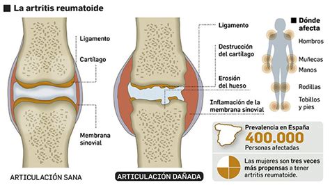 Esquema de una articulación sana y una articulación afectada por artrosis